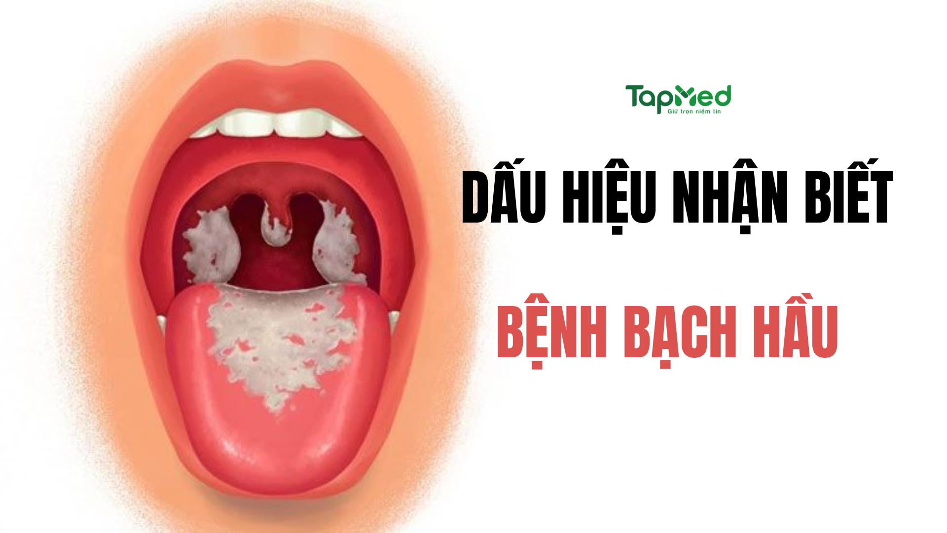 Dấu hiệu bệnh bạch hầu có dễ nhận biết?